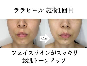 ブレリアントサロン 池袋店(brillant salon)/【30代】ララピール(施術1回目)