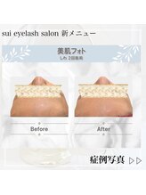 スイ(Sui)/美肌光フォトbefore after