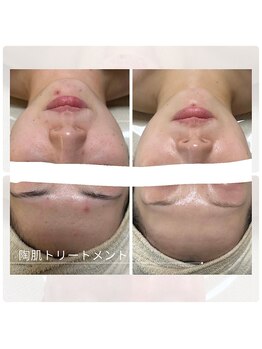 アチェリー(aCherry)/陶肌トリートメント