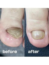 コトリ(Kotori)/【肥厚・変形爪リスタートケア】