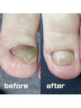 コトリ(Kotori)/【肥厚・変形爪リスタートケア】