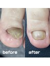 【肥厚・変形爪リスタートケア】