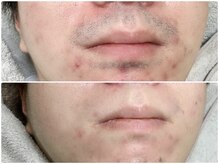 カルム(Calme)/ヒゲ脱毛　２０代