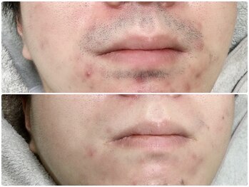 カルム(Calme)/ヒゲ脱毛 20代