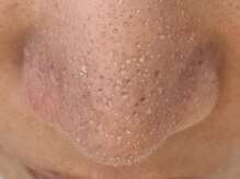 ウミ(Ummi)/角栓をしっかりふやかします