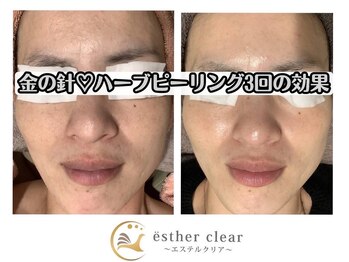 エステルクリア(esther clear)/剥離しない塗る金の針で艶感増!!