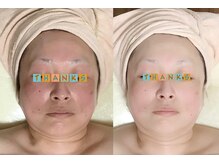 メディカルサロン かとれあ/フェイシャルエステ