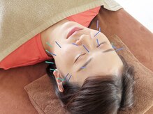 イーライフ鍼灸接骨院/美容鍼で肌質改善