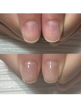 セラキュアネイル(Theracure nail)/ジェルネイル繰り返して傷んだ爪
