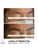 アクシア ビューティー サロン(AXSIA)/【HBL】BeforeAfter