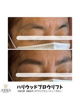 アクシア ビューティー サロン(AXSIA)/【HBL】BeforeAfter