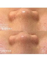 エース(ACE.)/毛穴洗浄☆いちご鼻、撃退！！