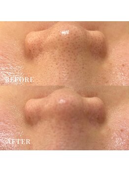 エース(ACE.)/毛穴洗浄☆いちご鼻、撃退!!