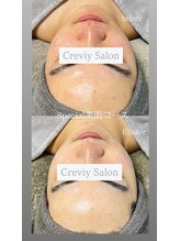 クレヴィー(Creviy)/Special美肌コース