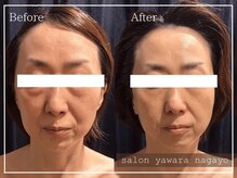 ヤワラ 長与店(yawara)/πテラピーBefore After