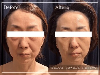 ヤワラ 長与店(yawara)/πテラピーBefore After