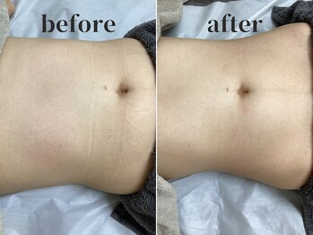 シンディー(CINDY)/腸もみビフォーアフター