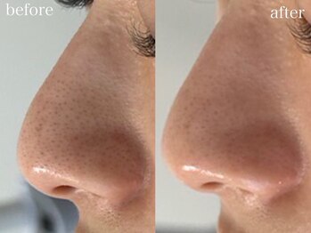 ホワイトアクア 池袋店(WHITE AQUA)/ハーブピーリング/毛穴洗浄/池袋