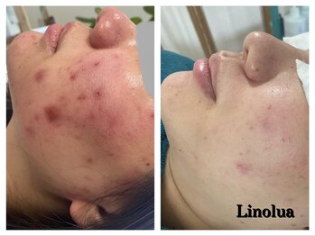 リノルーア(Linolua)/