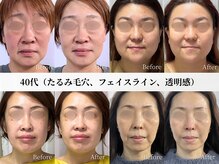 アストリエ グレース 相模大野(Astorie Grace)/リフトアップ｜Before→After