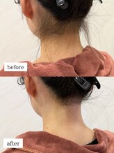 ワイズサロン(Y's salon)/うなじ脱毛