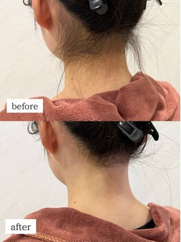 ワイズサロン(Y's salon)/うなじ脱毛