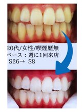 スマイルホワイト 赤羽店/ホワイトニングBefore After