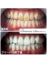 ホワイトニングサロン 京都烏丸店/ホワイトニング施術例　