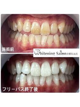 ホワイトニングサロン 京都烏丸店/ホワイトニング施術例　