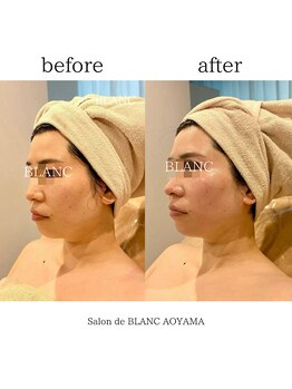 サロン ド ブラン アオヤマ(Salon de BLANC AOYAMA)/リフトアップで輪郭も整える