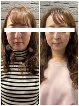 長寿鍼灸院 長寿整骨院/左右非対称のお顔に美容鍼★50本