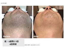 フェムーン(FEMOON)/【第一印象を極めるヒゲ脱毛】