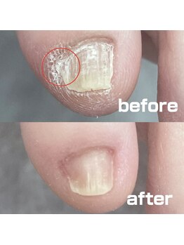 コトリ(Kotori)/【副爪ケア】