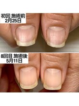 ベッレ マーニ/爪育成