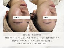 エメ(aimer)/LiftCare《小顔・リフトアップ》