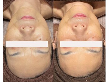 フェイスプラスリフ(FACE+RiF)/しわ改善