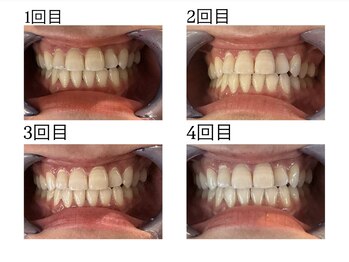 スマイルプライベートビューティサロン(Smile)/セルフホワイトニング