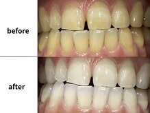 メルヴェイユ/東中野ホワイトニング