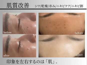 パールムーン(pearl moon)/繰り返す肌トラブルに終止符を。