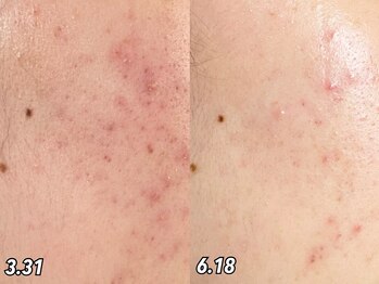 コム(comme39)/肌荒れで悩んでいる方