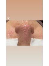 エステサロン桜/その場で、ツルツル卵肌に！