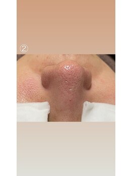 エステサロン桜/その場で、ツルツル卵肌に！