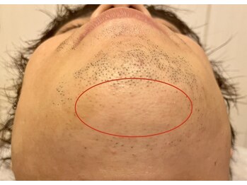 フィズ 松戸店(FIS)/☆脱毛途中経過☆［松戸/脱毛］