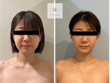 エムクリニカルラボ 藤沢(M clinical lab)/脂肪燃焼剤導入×小顔リンパ