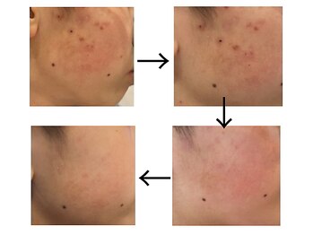 エジラランテ(esilarante)/REVI ハーブピーリング 症例