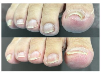 イルミナ(illumina)の写真/【巻き爪・変形爪の専門ケア】痛みの少ない最新技術で、歩くのが楽しくなる「健康で美しい足元」へ導きます