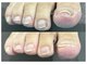 イルミナ(illumina)の写真/【巻き爪・変形爪の専門ケア】痛みの少ない最新技術で、歩くのが楽しくなる「健康で美しい足元」へ導きます