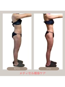 トレゾアスィス(Tresor sis)/痩身/ダイエット/筋膜リリース