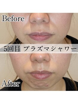 ラノン(LANON)/ビフォーアフター4