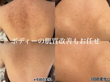 リラ(Lilas)の雰囲気（頑固な背中ニキビケアも得意です♪是非一度お任せください！）